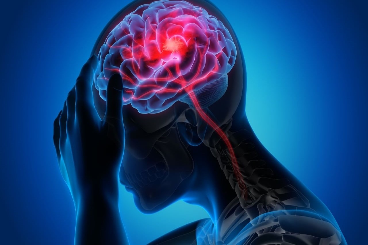 Understanding Migraines: A Psychological Perspective